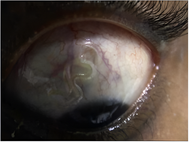 Close-up view of an eye showing unusual features including redness, a squiggly line, and visible blood vessels.